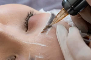 میکروپیگمنتیشن - سایت تروسا